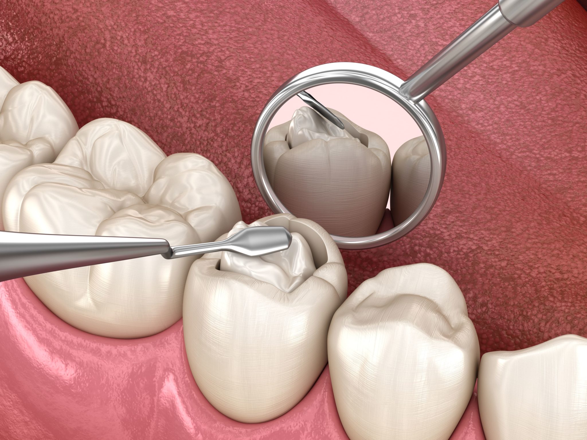 Sealing Vs Filling Cavities What s The Difference Acorn Dentistry 