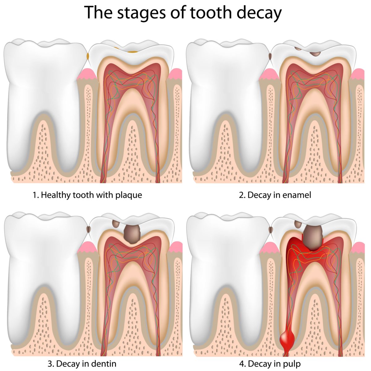 Albums 96+ Images 4 year old tooth decay pictures Excellent