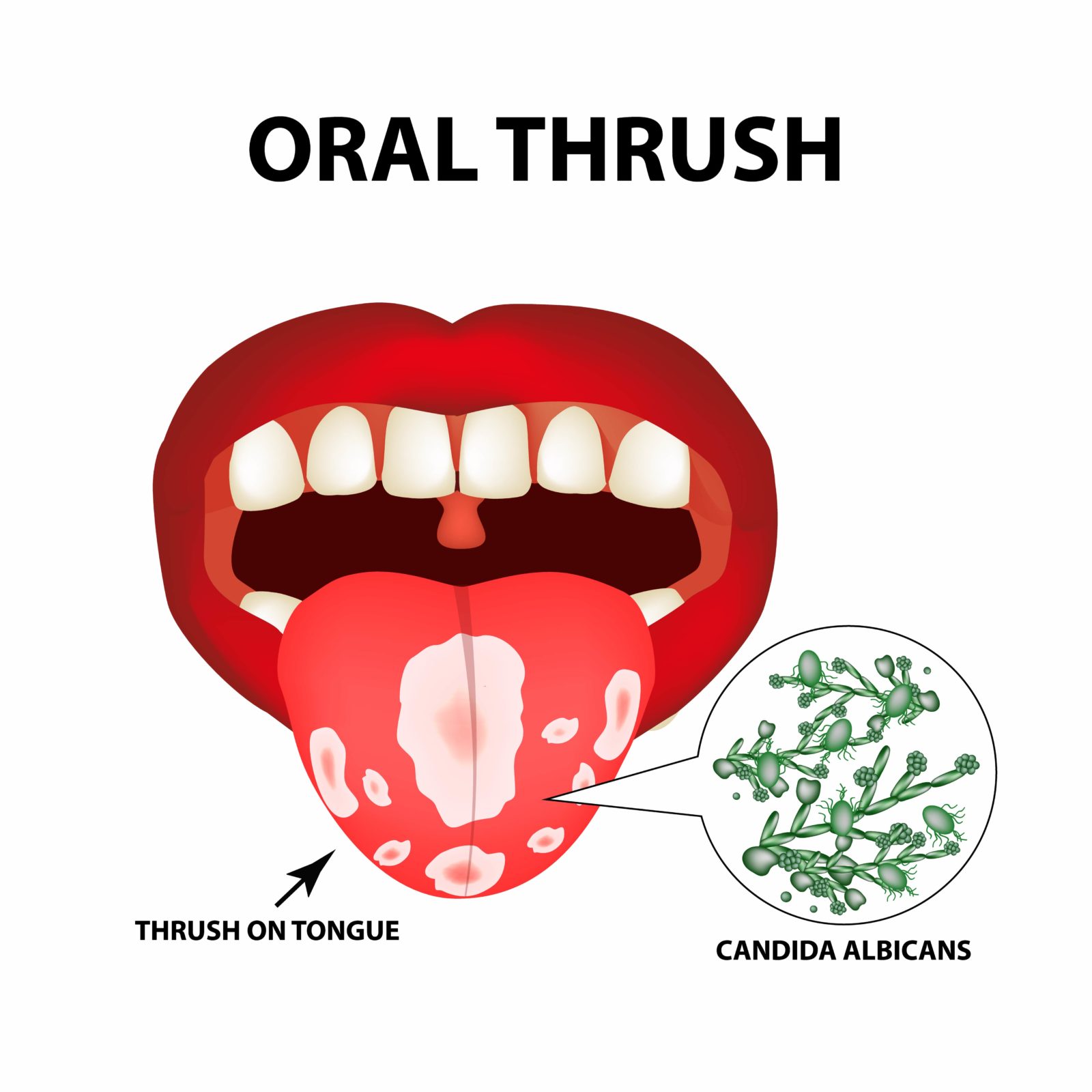 diagram of oral thrush on the tongue