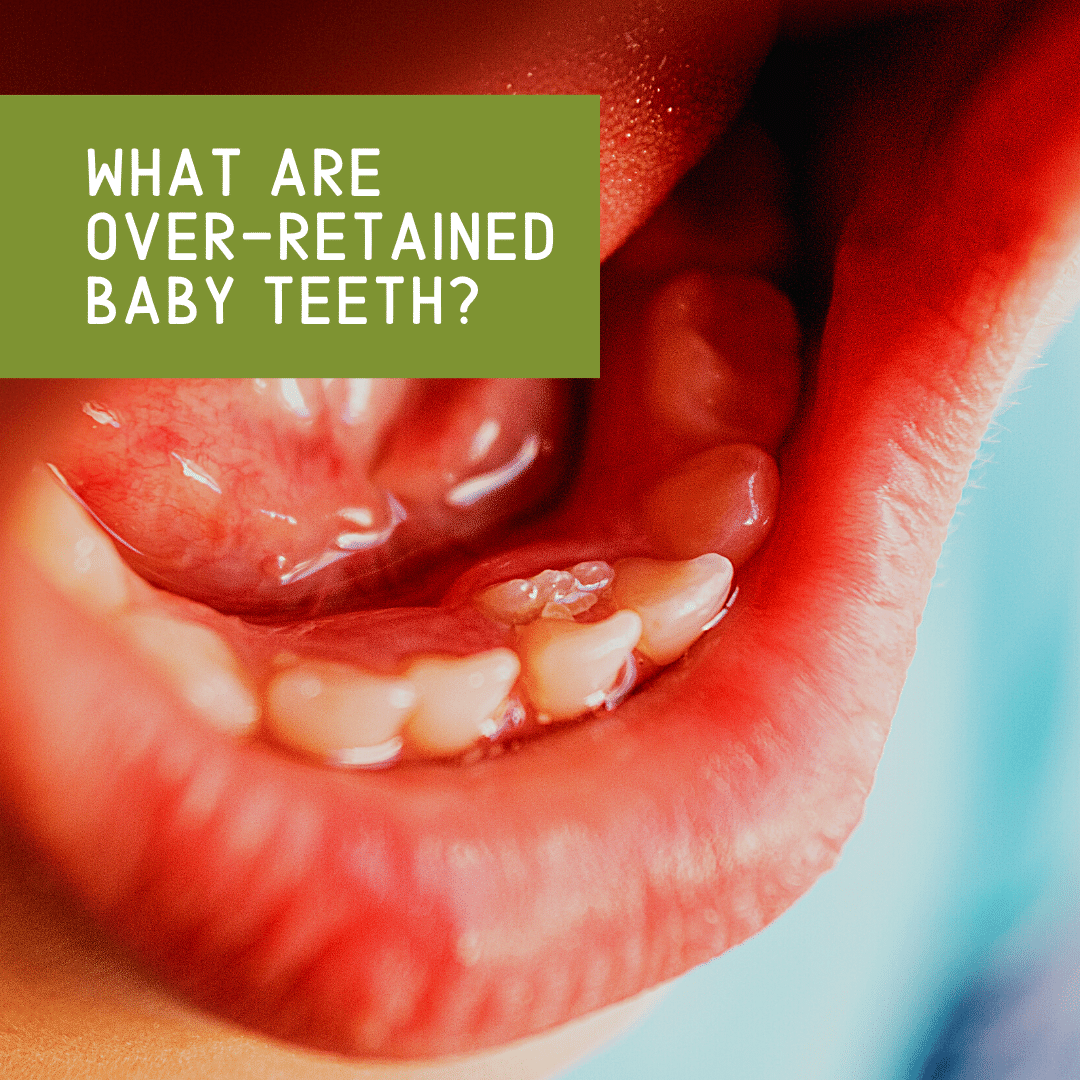 What are over-retained baby teeth_