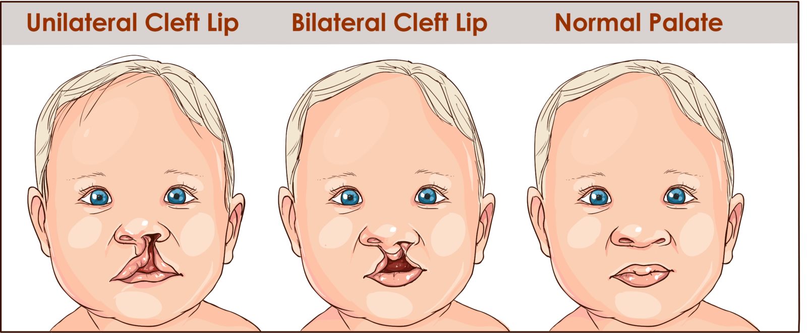 cleft left and palate