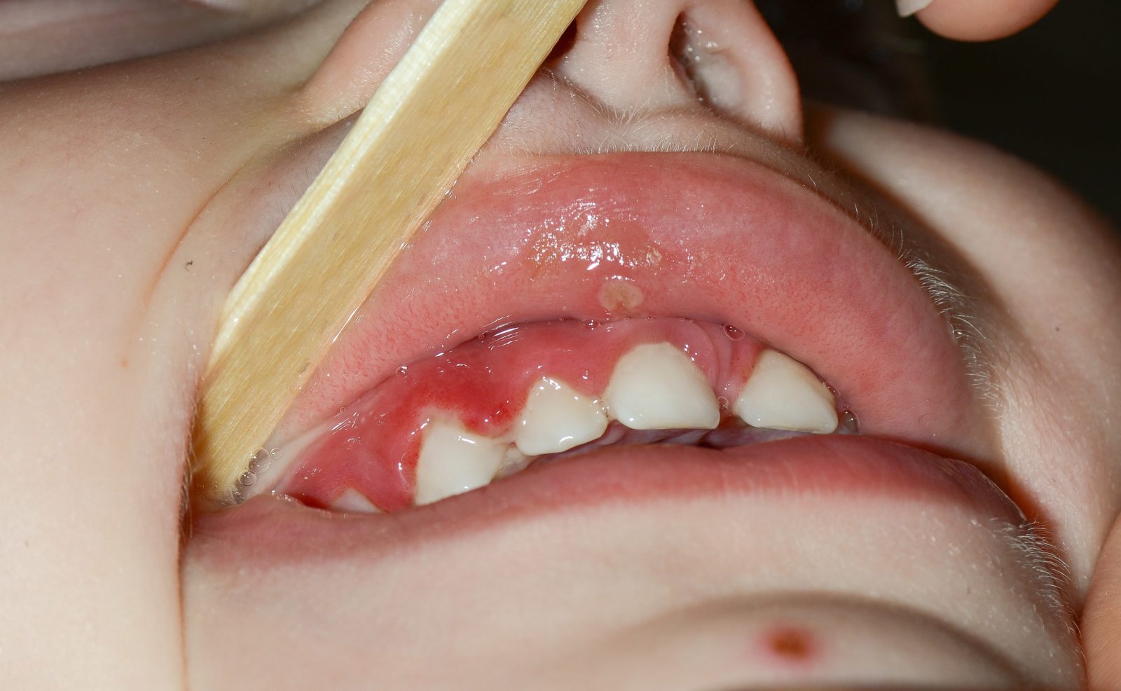 child's mouth with gum disease