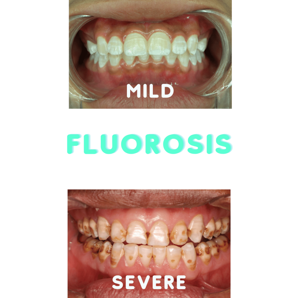 Ways To Prevent Fluorosis Acorn Dentistry For Kids