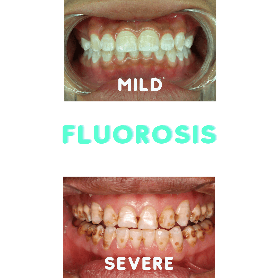 mild and severe cases of fluorosis